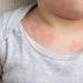 Heat Rashes vs. Allergic Reactions: How to Tell the Difference Fast